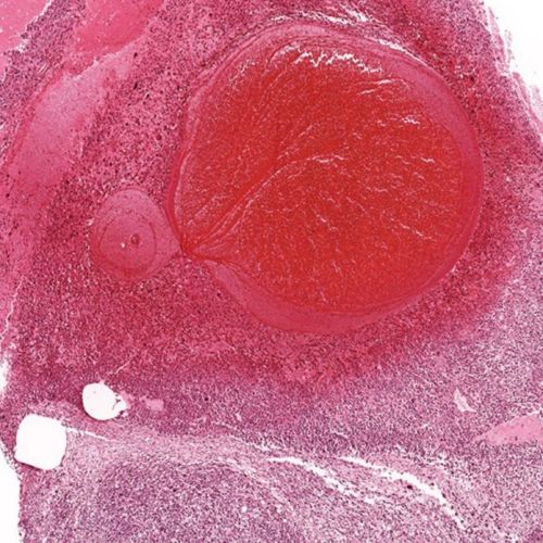 Gliomas and cardiac schwannomas from lifetime exposure of rats to low dose far field RFR