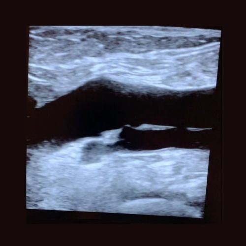 EHT study rolloux effect