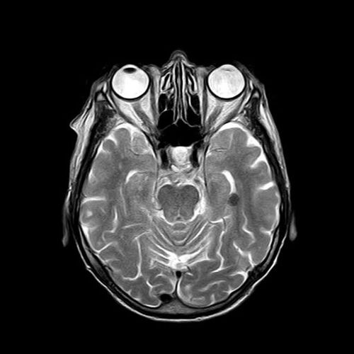 Glioblastoma in 15-39 year-olds: 230% increase in 20 years!